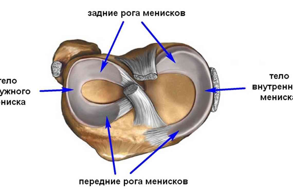 Розрив меніска