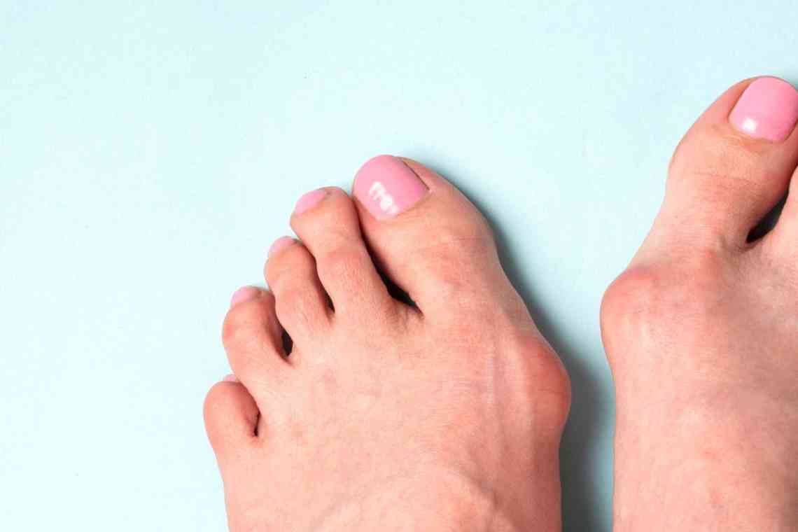 Hallux valgus (Вальгусна деформація першого пальця стопи)