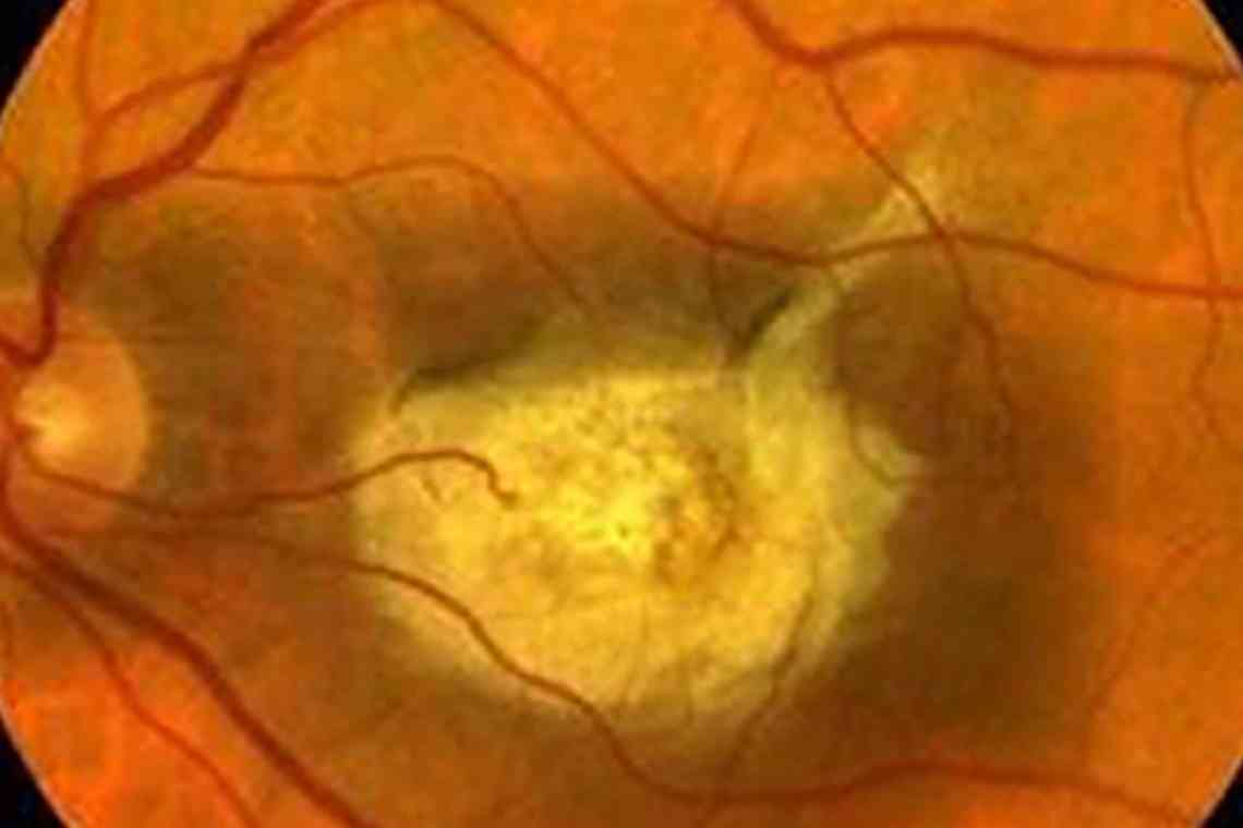 Пігментний ретинит