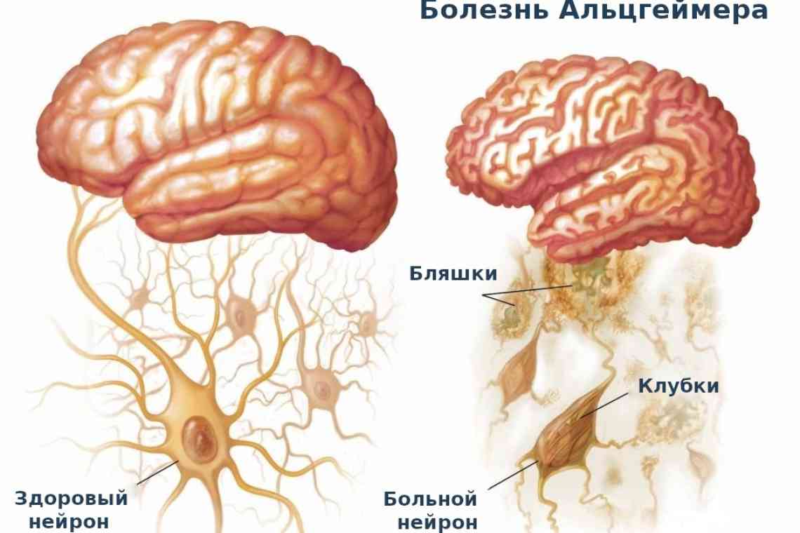 Концентричний склероз Бало (хвороба Бало)