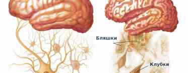 Концентричний склероз Бало (хвороба Бало)