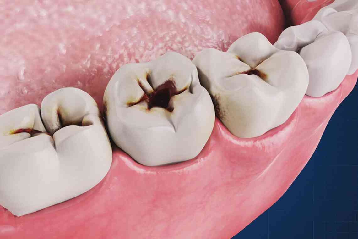 Захворювання твердих тканин зуба