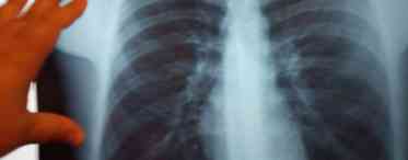 Секвестрація легені