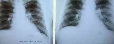 Гемангіома легенів