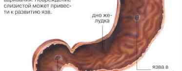 Функціональні розлади шлунка