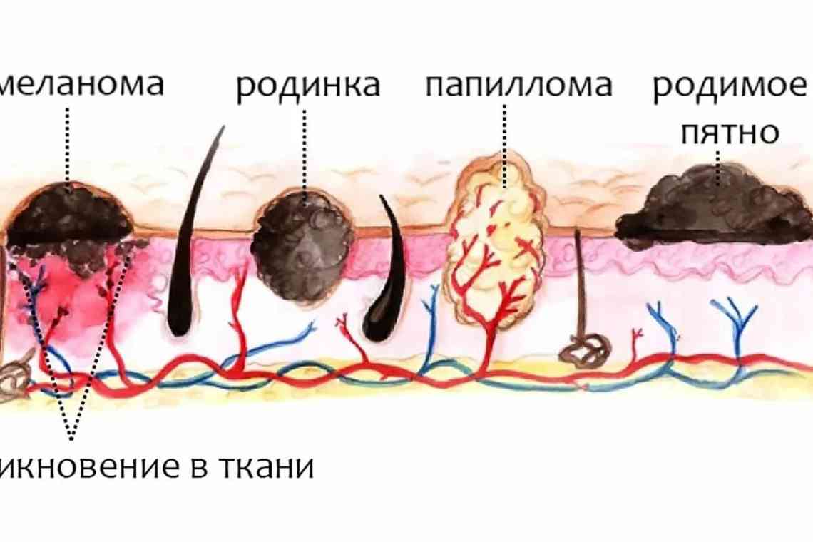 До чого сняться родимки